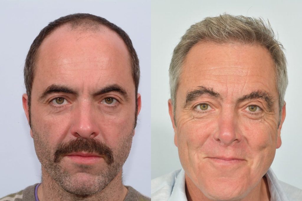 Hair Thinning: Causes, Treatments, and What You Can Do?